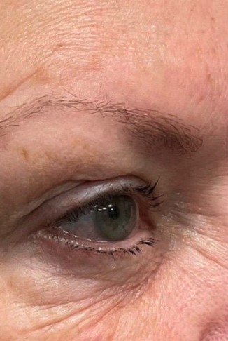 Before eyelid treatment